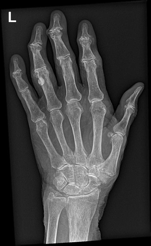 Röntgenaufnahme einer Hand mit Arthrose in allen dargestellten Gelenken